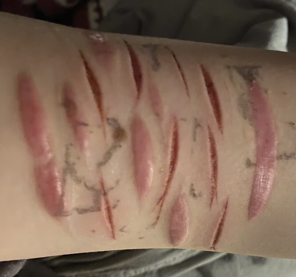 Can’t wait for this shit to get infected🥰