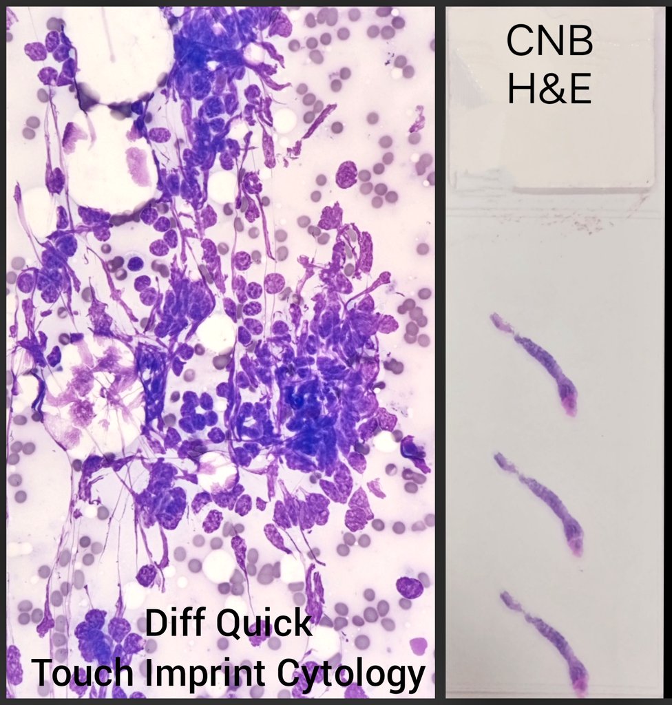 duckhuca's tweet photo. 👃🏽 Medical record: Olfactory Neuroblastoma.
🏥 Cervical Lymph Node.
💉 Ultrasound guided core needle biopsy performed by Interventional Pathologist ➕ Touch Imprint Cytology ➕ ROSE 🌹.
🔬 Metastatic Neuroblastoma.
#PathX #PathTwitter https://t.co/ggPwlHWVUB