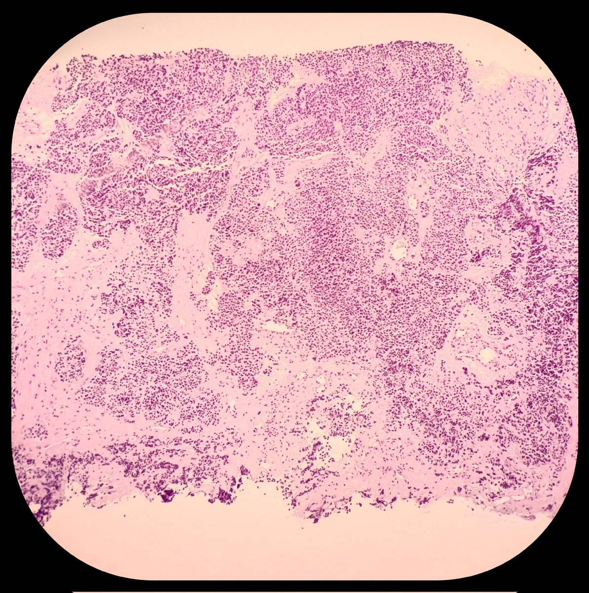 duckhuca's tweet photo. 👃🏽 Medical record: Olfactory Neuroblastoma.
🏥 Cervical Lymph Node.
💉 Ultrasound guided core needle biopsy performed by Interventional Pathologist ➕ Touch Imprint Cytology ➕ ROSE 🌹.
🔬 Metastatic Neuroblastoma.
#PathX #PathTwitter https://t.co/ggPwlHWVUB
