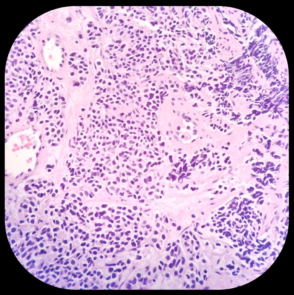 duckhuca's tweet photo. 👃🏽 Medical record: Olfactory Neuroblastoma.
🏥 Cervical Lymph Node.
💉 Ultrasound guided core needle biopsy performed by Interventional Pathologist ➕ Touch Imprint Cytology ➕ ROSE 🌹.
🔬 Metastatic Neuroblastoma.
#PathX #PathTwitter https://t.co/ggPwlHWVUB