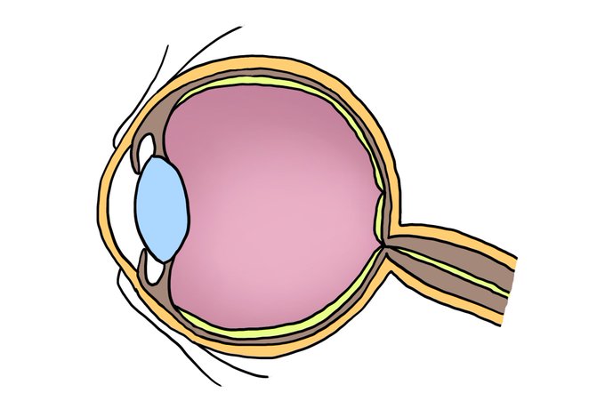 ご無沙汰しちゃって申し訳ないです😱
白内障手術して今月再検査したら視力0.2に下がってた…
相変わらず左眼はよく見えず…別の眼科行ったりして色々検査して何となく原因が分かってきたのだけど、オイラの場合普通の眼球と違って生まれつき奥歪んだ形のせいで視力が0.01以下…
正常な眼←オイラの眼→ 
