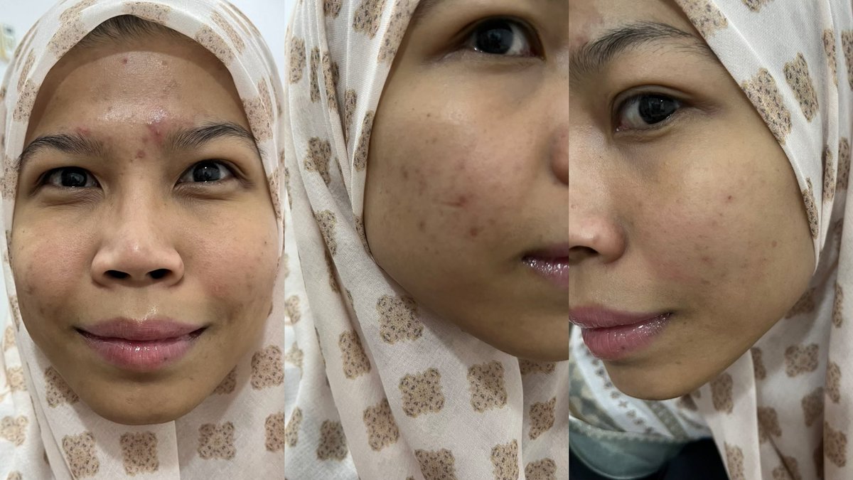 HanisShaika's tweet photo. Tak percaya langsung i pakai 1 serum ni je kecut terus jerawat dan dpt pudarkan parut sekali. Bangga dgn diri sendiri sbb berjaya tackle my acne problem.

From this https://t.co/AyxRoHeGIx