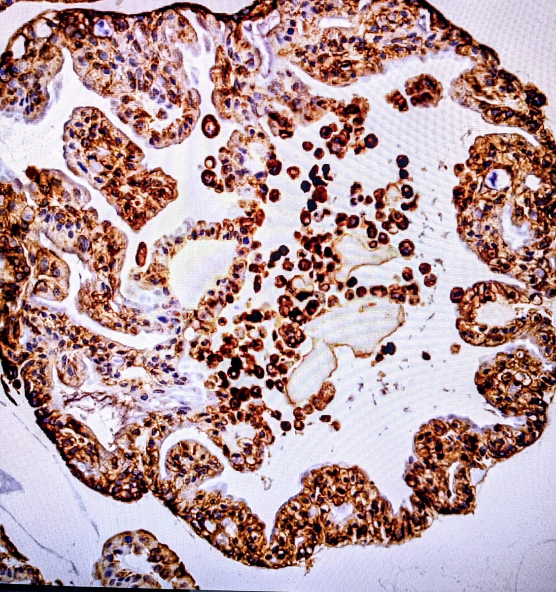 BenjaminDwyer4's tweet image. Here's one of our tumeroid IHC's from our departing RA @NathanMain16 - we will miss his awesome lab skills, but all the best for the postdoc!
#organoids #livercancer