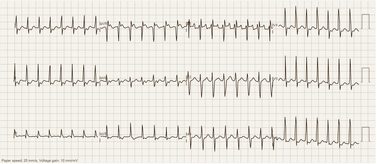 ecgandrhythmRoe's tweet photo. ECG arrived by e-mail; 24-year-old woman, palpitations; most likely diagnosis? https://t.co/sToecgAQ2d