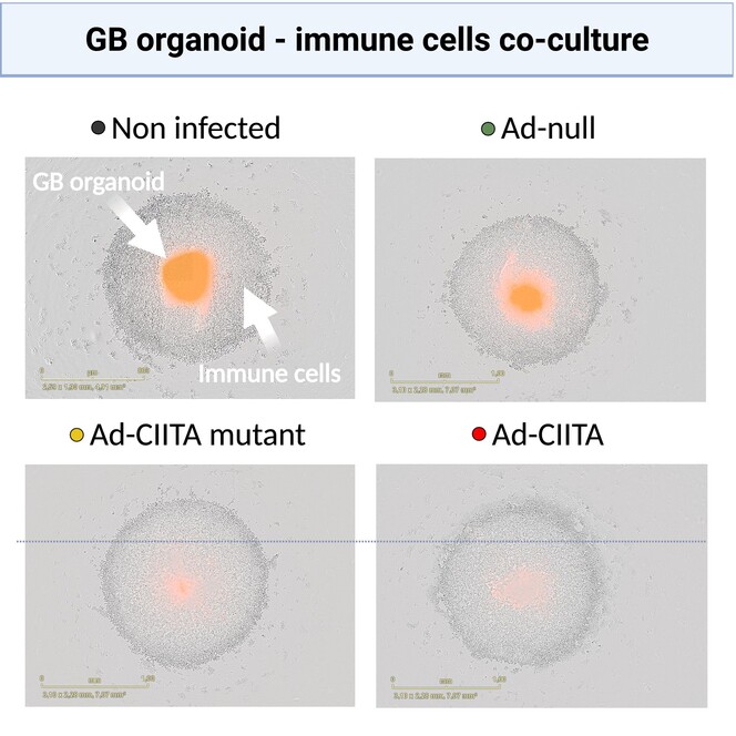 Molecular Oncology (@moloncology) on Twitter photo Adenoviral delivery of the CIITA transgene induces T-cell-mediated killing in glioblastoma organoids
👉buff.ly/3V9vUwl
🥼<a href="/PoliAurelie/">Aurélie Poli</a> <a href="/ElianeKlein09/">Eliane Klein</a> <a href="/marchini1430/">Antonio Marchini</a> <a href="/AnGolebiewska/">Anna Golebiewska</a> <a href="/AnujaLipsa/">Anuja Lipsa, PhD</a>
#Organoids #TumourOrganoids
#Oncolytic #Immunotherapy Adenoviral delivery of the CIITA transgene induces T-cell-mediated killing in glioblastoma organoids
👉buff.ly/3V9vUwl
🥼<a href="/PoliAurelie/">Aurélie Poli</a> <a href="/ElianeKlein09/">Eliane Klein</a> <a href="/marchini1430/">Antonio Marchini</a> <a href="/AnGolebiewska/">Anna Golebiewska</a> <a href="/AnujaLipsa/">Anuja Lipsa, PhD</a>
#Organoids #TumourOrganoids
#Oncolytic #Immunotherapy