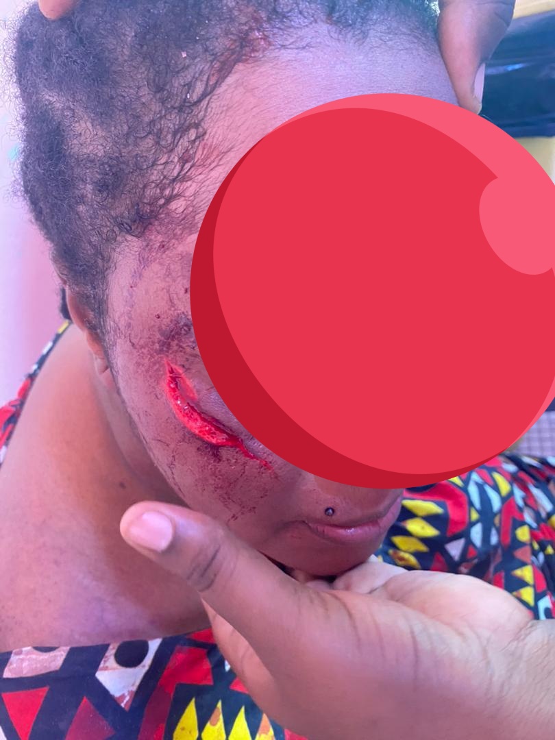 jalybadiane's tweet photo. #StopVBG Oui ça va vous choquer ! Nonnnnnnn la majorité d'entre nous ne le sera pas; nous allons juste nous indigner momentanément, scroller et passer à autre chose !
Et pire, certains vont demander "ce qu'elle a pu faire pour être battu"; d'autres vont demander "à écouter la version du bourreau avant de se faire une idée". Voilà comment dans ce pays on normalise et banalise les violences faites aux femmes et au filles.

Dieynaba (sur les photos) est en prison ! Heyyyy oui elle est la victime mais c'est elle qui croupir en prison; elle a été condamnée à 3 mois de prison ferme pour détention d'images à caractère personnel. Et son bourreau, grâce à une forte mobilisation populaire, a finalement ete arrêté et condamné à 45 JOURS de prison pour coups et blessures volontaires : c'est une hérésie !

Et quel message de la justice sénégalaise aux victimes : on vous tabasse, vous balafre, vous mutile, et si vous ne médiatisez votre "cas" voud avez peu de chance d'être entendu et si par hasard votre bourreau est arrêté et bien il va juste écoper d'une petite peine. C'est exactement cela que l'on dit aux femmes et aux filles !

Dieynaba est le symbole d'une lutte pour les millions de femmes au Sénégal, en Afrique et ailleurs dans le monde qui subissent des violences basées sur le genre.

Nous ne pouvons pas continuer à faire les autruches face à ces violences et l'impunité dans laquelle baigne les bourreaux !

Les VBG, il faut que ça cesse ‼️

#16jours d'activisme contre les violences basées sur le genre.