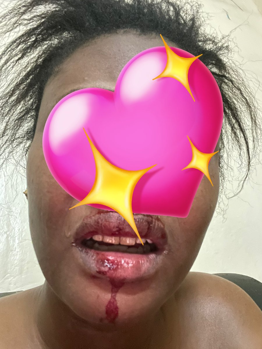 jalybadiane's tweet photo. #StopVBG Oui ça va vous choquer ! Nonnnnnnn la majorité d'entre nous ne le sera pas; nous allons juste nous indigner momentanément, scroller et passer à autre chose !
Et pire, certains vont demander "ce qu'elle a pu faire pour être battu"; d'autres vont demander "à écouter la version du bourreau avant de se faire une idée". Voilà comment dans ce pays on normalise et banalise les violences faites aux femmes et au filles.

Dieynaba (sur les photos) est en prison ! Heyyyy oui elle est la victime mais c'est elle qui croupir en prison; elle a été condamnée à 3 mois de prison ferme pour détention d'images à caractère personnel. Et son bourreau, grâce à une forte mobilisation populaire, a finalement ete arrêté et condamné à 45 JOURS de prison pour coups et blessures volontaires : c'est une hérésie !

Et quel message de la justice sénégalaise aux victimes : on vous tabasse, vous balafre, vous mutile, et si vous ne médiatisez votre "cas" voud avez peu de chance d'être entendu et si par hasard votre bourreau est arrêté et bien il va juste écoper d'une petite peine. C'est exactement cela que l'on dit aux femmes et aux filles !

Dieynaba est le symbole d'une lutte pour les millions de femmes au Sénégal, en Afrique et ailleurs dans le monde qui subissent des violences basées sur le genre.

Nous ne pouvons pas continuer à faire les autruches face à ces violences et l'impunité dans laquelle baigne les bourreaux !

Les VBG, il faut que ça cesse ‼️

#16jours d'activisme contre les violences basées sur le genre.