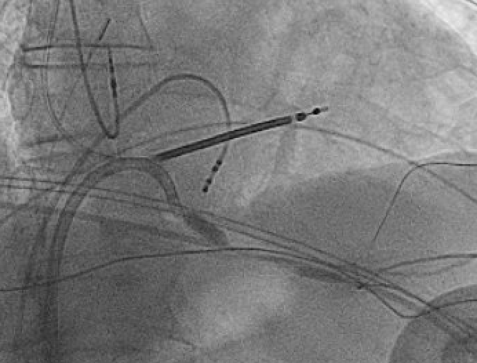 Babak Nazer (@b_naz_md) on Twitter photo #AblateVT more fun as a team. Post-infarct mid-inferosept VT inaccessible from RV, LV & epi. Double balloon EtOH via MCV worked w/ help choosing balloons & wires from <a href="/jamiemccabeMD/">Jamie McCabe</a> & <a href="/DavidElison1/">David Elison</a>. Thx to @MiguelVldrbno for tips & tricks during <a href="/UWMedHeart/">UWashington Heart Institute</a> EP research conf. #AblateVT more fun as a team. Post-infarct mid-inferosept VT inaccessible from RV, LV & epi. Double balloon EtOH via MCV worked w/ help choosing balloons & wires from <a href="/jamiemccabeMD/">Jamie McCabe</a> & <a href="/DavidElison1/">David Elison</a>. Thx to @MiguelVldrbno for tips & tricks during <a href="/UWMedHeart/">UWashington Heart Institute</a> EP research conf.