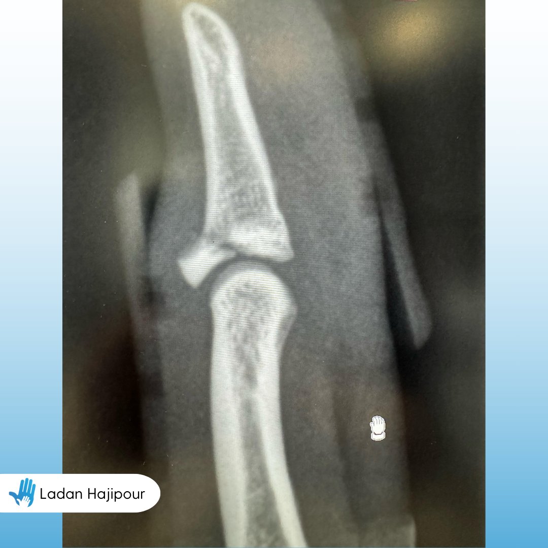 Bony mallet fractures are a common injury among rugby players, often occurring when the fingertip is forcefully flexed during contact.

Early treatment is key to ensuring the best outcome, so if you’ve suffered a finger injury, assess it promptly! 🏉👆

#RugbyInjury #MalletFinger