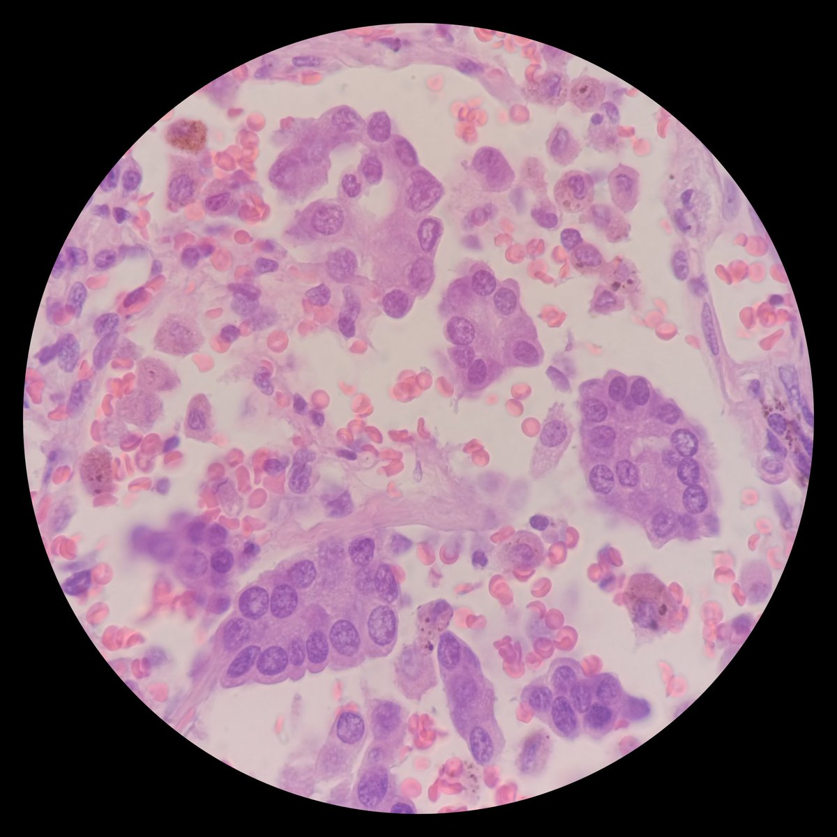 🫁 Adenocarcinoma.
🌬️ Spread Through Air Spaces.
➕ STAS.
#LungPath #LungCancer #PathX #PathTwitter