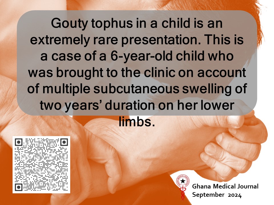 Ghana Medical Journal (@ghanamedj) on Twitter photo Multiple gouty tophi in a six-year-old
ghanamedj.org/articles/Septe…
<a href="/ghanamedj/">Ghana Medical Journal</a>
<a href="/GhanaMedAssoc/">Ghana Medical Association</a>
<a href="/TheLancet/">The Lancet</a>
<a href="/WHOAFRO/">WHO African Region</a>
<a href="/AJPPEditors/">African Journals</a>
<a href="/AJOLinfo/">AJOLinfo</a> Multiple gouty tophi in a six-year-old
ghanamedj.org/articles/Septe…
<a href="/ghanamedj/">Ghana Medical Journal</a>
<a href="/GhanaMedAssoc/">Ghana Medical Association</a>
<a href="/TheLancet/">The Lancet</a>
<a href="/WHOAFRO/">WHO African Region</a>
<a href="/AJPPEditors/">African Journals</a>
<a href="/AJOLinfo/">AJOLinfo</a>
