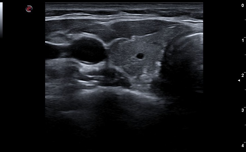 Quieres formarte en Eco De Tiroides?? Esta es tu oportunidad: Nuevo curso online de "Ecografía Clínica en la Región Cervical Anterior" de <a href="/somamfyc/">SoMaMFyC</a> - Comenzamos el 3 de febrero. toda la info👉somamfyc.com/mc-events/curs…