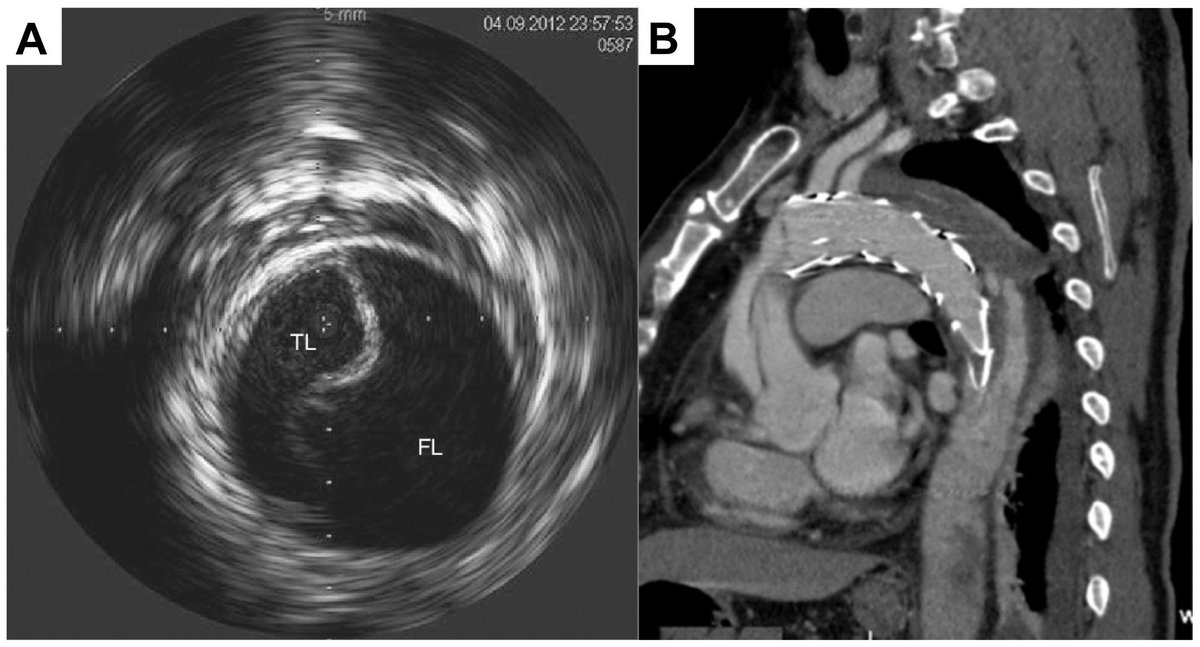USC Vascular Surgery (@usc_vascular) on Twitter photo "What can go wrong during thoracic endovascular aortic repair for type B aortic dissection"
Some words of wisdom from integrated resident Dr. Zach Rengel and Dr. Greg Magee (<a href="/gregamagee/">Gregory A. Magee, MD MSc</a>) from the pages of <a href="/JVascSurgCIT/">JVS-Cases Innovations and Techniques</a>
#aortaed #tbad #tevar
jvscit.org/article/S2468-… "What can go wrong during thoracic endovascular aortic repair for type B aortic dissection"
Some words of wisdom from integrated resident Dr. Zach Rengel and Dr. Greg Magee (<a href="/gregamagee/">Gregory A. Magee, MD MSc</a>) from the pages of <a href="/JVascSurgCIT/">JVS-Cases Innovations and Techniques</a>
#aortaed #tbad #tevar
jvscit.org/article/S2468-…