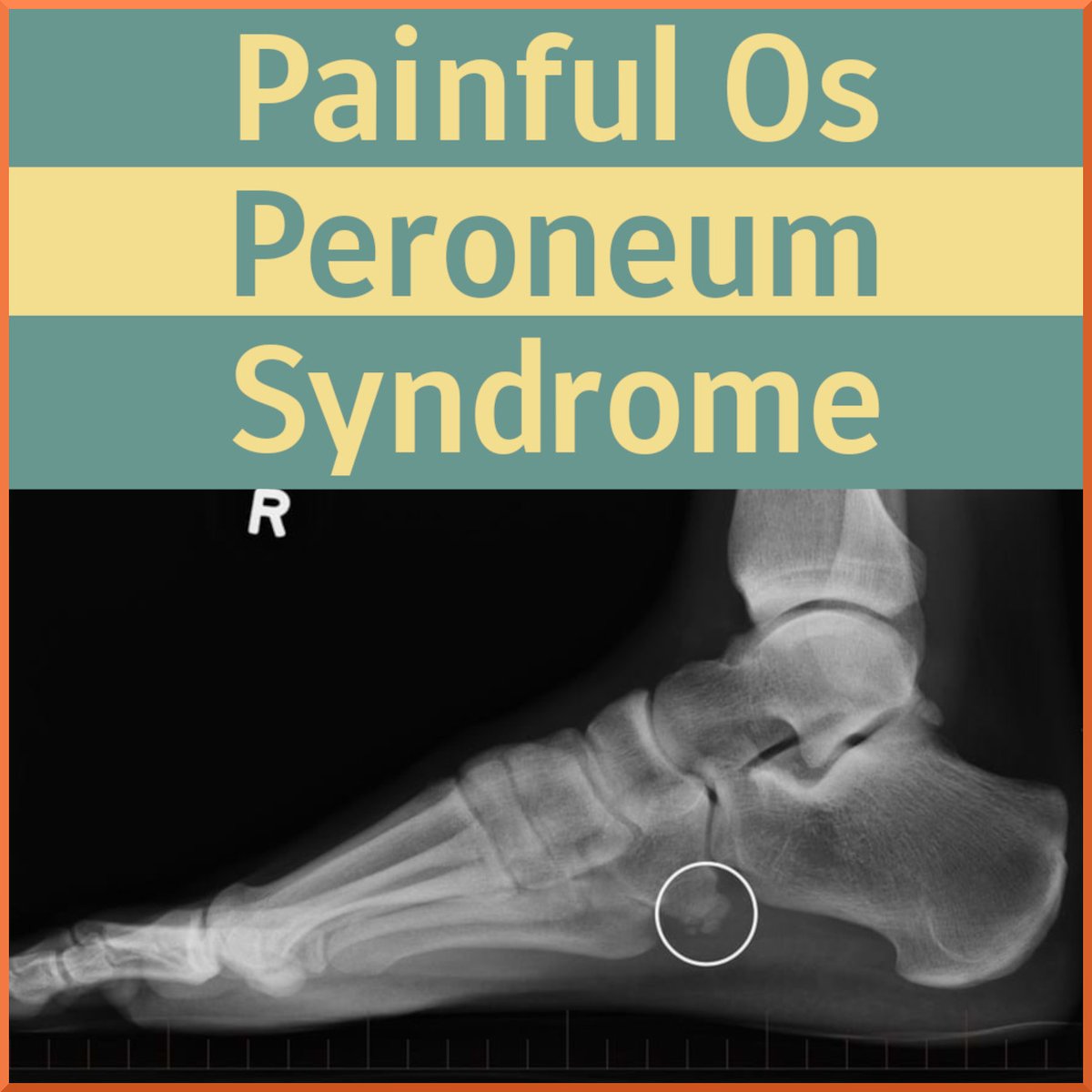 SportsMedReview's tweet photo. This week Dr reviews Painful Os Peroneum Syndrome, a rare condition poorly described in the literature!. Read More!

Read More:
https://t.co/Do9ckARHgb

#sportsmed #sportsmedicine #ebm #medicine #sports #foamSM #MedEd #FOAMed #ortho #medtwitter #OrthoTwitter #physicaltherapy #athletictraining
