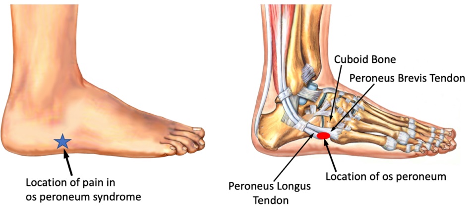 SportsMedReview's tweet photo. This week Dr reviews Painful Os Peroneum Syndrome, a rare condition poorly described in the literature!. Read More!

Read More:
https://t.co/Do9ckARHgb

#sportsmed #sportsmedicine #ebm #medicine #sports #foamSM #MedEd #FOAMed #ortho #medtwitter #OrthoTwitter #physicaltherapy #athletictraining