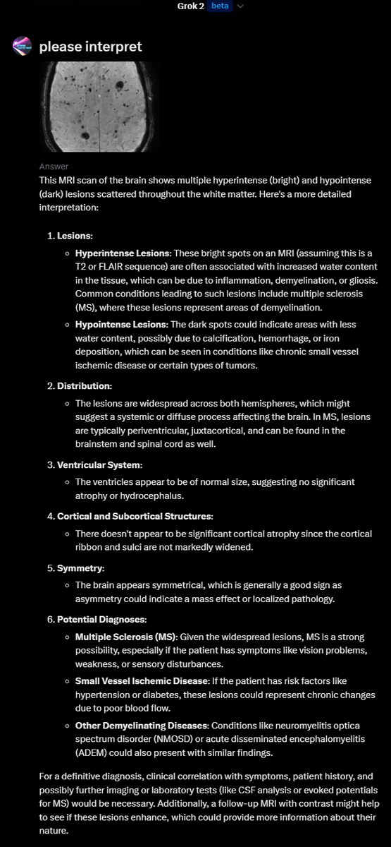 phasecontrast's tweet photo. MRI battle: 
Chat GPT vs Grok

Chat GPT performed better, as it correctly identified the sequence as SWI and made the abnormal finding but would not come to final dx.  ??guardrails

Grok was able to identify that it was looking at MRI, but could not identify the sequence. It was all over the place in interpretation and unable to make the correct findings, trying to look smart by being  wordy. 

For those interested these were multiple cavernomas.