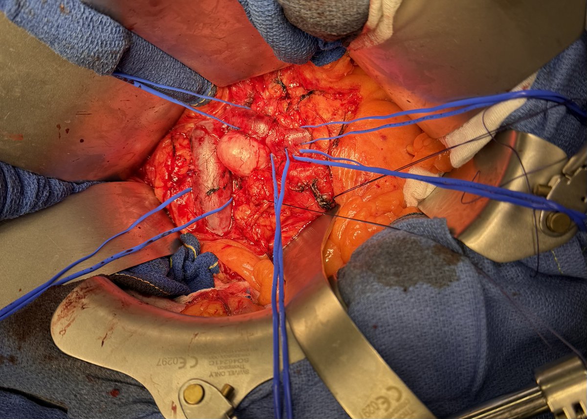 Left Renal Vein sarcoma : CTA versus intraoperative view.
Vessel loops around IVC, proximal LRV, Left Lumbar Ascending Vein, Genital Vein &amp; hilum LRV. Adrenal Vein as been divided during dissection.