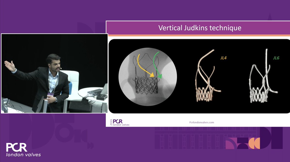 Jonathan Curio (@curiojonathan) on Twitter photo Whole AS liftetime in just 1 hour: Possible @ #PCRLV Simulation Lab
🎯Alignment+coronary access are key
➡️Simulation teaches all new techniques
<a href="/DrArifK/">Arif Khokhar</a>
<a href="/PamelaGatto/">Pamela Gatto</a> <a href="/TagliariPaula/">Ana Paula Tagliari</a> <a href="/dr_serkanasil/">Doc. Dr. Serkan Asil</a> <a href="/guilbon/">Guillaume Bonnet</a> <a href="/MiChen__/">Mi Chen 陈密</a> <a href="/denisamuraru/">Denisa Muraru</a> <a href="/dr_tyxiong/">Tianyuan</a> <a href="/ABeneduceMD/">Alessandro Beneduce</a> <a href="/Dr_Harriet/">Harriet Hurrell</a> <a href="/EZancanaroMD/">Edoardo Zancanaro MD</a> Whole AS liftetime in just 1 hour: Possible @ #PCRLV Simulation Lab
🎯Alignment+coronary access are key
➡️Simulation teaches all new techniques
<a href="/DrArifK/">Arif Khokhar</a>
<a href="/PamelaGatto/">Pamela Gatto</a> <a href="/TagliariPaula/">Ana Paula Tagliari</a> <a href="/dr_serkanasil/">Doc. Dr. Serkan Asil</a> <a href="/guilbon/">Guillaume Bonnet</a> <a href="/MiChen__/">Mi Chen 陈密</a> <a href="/denisamuraru/">Denisa Muraru</a> <a href="/dr_tyxiong/">Tianyuan</a> <a href="/ABeneduceMD/">Alessandro Beneduce</a> <a href="/Dr_Harriet/">Harriet Hurrell</a> <a href="/EZancanaroMD/">Edoardo Zancanaro MD</a>