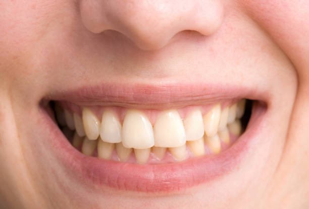 Just a reminder, your teeth can be healthy without being white!

Your teeth don’t have to be white to be healthy, and your teeth being white as snow doesn’t mean they are healthy.

Your teeth can be naturally slightly yellow and that’s fine. 

The tooth has 3 parts; enamel,
