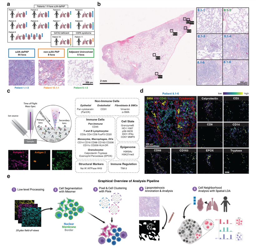 LabWaggoner's tweet photo. IFNγ-expressing myeloid cells localize within lipoproteinosis during drug-associated pulmonary alveolar proteinosis occurring in SJIA
https://t.co/9yuzdOmhwC
@ErinMcCaffrey14 @VivianSaper https://t.co/5xdnSaygw6