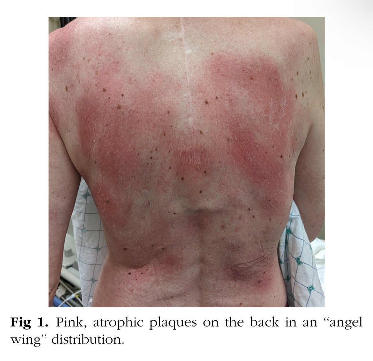 alb_giraldo's tweet photo. 'Angel wings' sign is a poikilodermatous eruption reported in anti‐small ubiquitin‐like modifier activating enzyme antibody (anti-SAE) positive dermatomyositis (DM). It is characterized by bright pink, slightly atrophic, painful plaques on the back with an “angel wings” distribution. Anti-SAE positive DM is a rare subgroup associated with typical skin features but a potentially diffuse rash, a mild myopathy, and interstitial lung disease defining an organizing pneumonia pattern. Cancer associated DM prevalence is five times that of the general population.

🔗https://t.co/hyXF3W7eGU