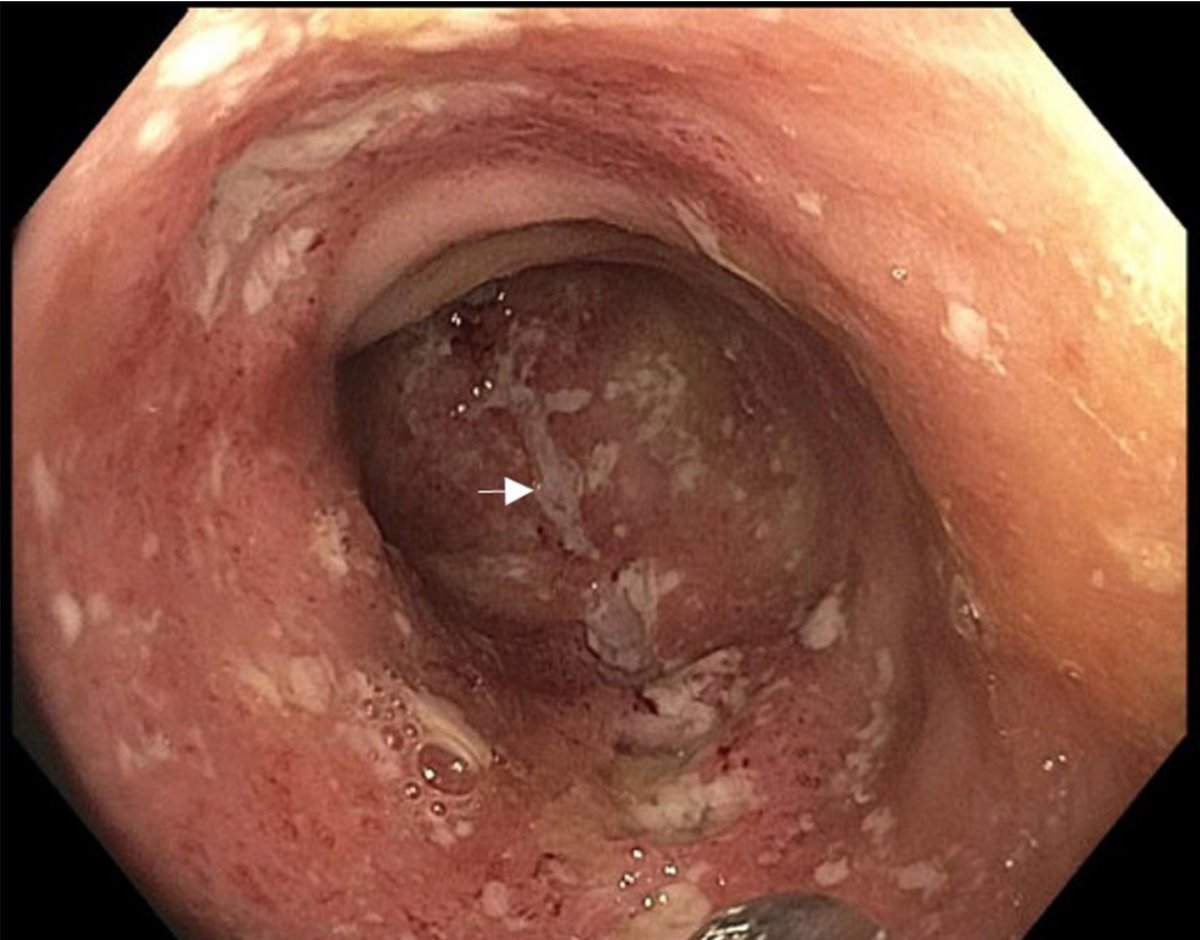 ACGCRJ (@acgcrj) on Twitter photo 🗣️ Image Challenge⏱️ #ACGCRJ
👉🏼What are sigmoid colon image findings?
👉🏼What are your differentials?
📚bit.ly/411H7CY
<a href="/AmCollegeGastro/">ACG</a> <a href="/NadeemYousafMD/">Nadeem Yousaf</a> <a href="/PrateekHarne1/">Prateek Harne MBBS, MD</a> <a href="/HFHIntMedRes/">Henry Ford Hospital Internal Medicine Residency</a> <a href="/HenryFordHealth/">Henry Ford Health</a> #GITwitter #MedTwitter <a href="/HZaverMD/">Himesh Zaver, MD</a> <a href="/AbelJosephMD/">Abel Joseph</a> <a href="/DushDahiya/">Dushyant Singh Dahiya, MD</a> <a href="/umer446/">Umer Farooq</a> 🗣️ Image Challenge⏱️ #ACGCRJ
👉🏼What are sigmoid colon image findings?
👉🏼What are your differentials?
📚bit.ly/411H7CY
<a href="/AmCollegeGastro/">ACG</a> <a href="/NadeemYousafMD/">Nadeem Yousaf</a> <a href="/PrateekHarne1/">Prateek Harne MBBS, MD</a> <a href="/HFHIntMedRes/">Henry Ford Hospital Internal Medicine Residency</a> <a href="/HenryFordHealth/">Henry Ford Health</a> #GITwitter #MedTwitter <a href="/HZaverMD/">Himesh Zaver, MD</a> <a href="/AbelJosephMD/">Abel Joseph</a> <a href="/DushDahiya/">Dushyant Singh Dahiya, MD</a> <a href="/umer446/">Umer Farooq</a>