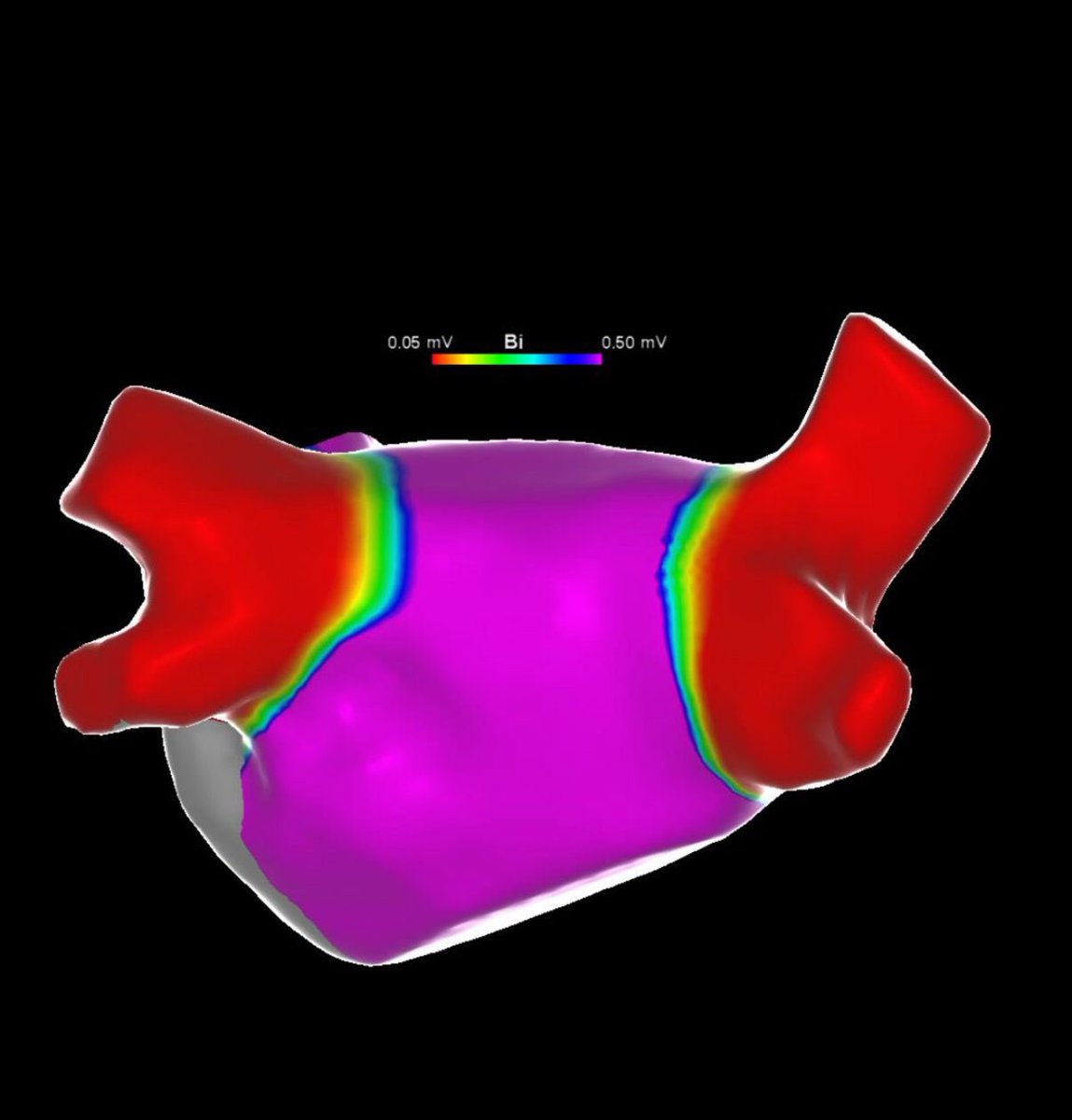 Fengwei Jasper Zou (@jasperzoumd) on Twitter photo Excited to assess PFA durability (VARIPULSE) in a redo AF case from the AdmIRE trial. Pic shows durable PVI from index ablation 2yrs ago in PVI only case mandated by protocol. <a href="/LuigiDiBiaseMD/">Luigi Di Biase</a> <a href="/AndyZhangMD/">Xiaodong Zhang (Andy), MD, PhD, FHRS, FACC</a> <a href="/GrupposoVito/">Vito Grupposo</a> <a href="/MontefioreNYC/">Montefiore Health System</a> <a href="/HRSonline/">Heart Rhythm Society</a> <a href="/ACCinTouch/">American College of Cardiology</a> <a href="/escardio/">European Society of Cardiology</a> #ehra Excited to assess PFA durability (VARIPULSE) in a redo AF case from the AdmIRE trial. Pic shows durable PVI from index ablation 2yrs ago in PVI only case mandated by protocol. <a href="/LuigiDiBiaseMD/">Luigi Di Biase</a> <a href="/AndyZhangMD/">Xiaodong Zhang (Andy), MD, PhD, FHRS, FACC</a> <a href="/GrupposoVito/">Vito Grupposo</a> <a href="/MontefioreNYC/">Montefiore Health System</a> <a href="/HRSonline/">Heart Rhythm Society</a> <a href="/ACCinTouch/">American College of Cardiology</a> <a href="/escardio/">European Society of Cardiology</a> #ehra
