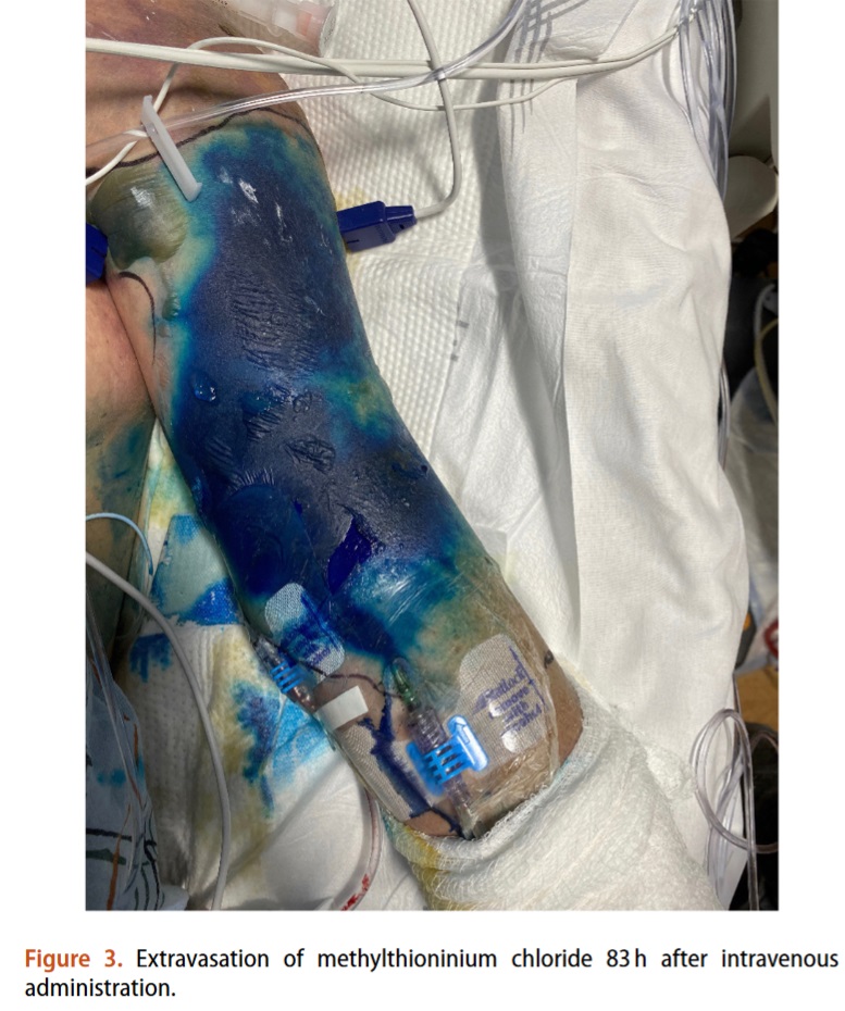 A 38-year-old woman presented to the emergency department with shock. She was treated with an infusion of methylthioninium chloride for refractory shock. The methylthioninium chloride extravasated and led to blue staining of the left upper arm.
tandfonline.com/doi/full/10.10…