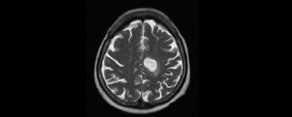 News: Eflornithine Improves Survival in Brain Cancer. bit.ly/3OsP10N