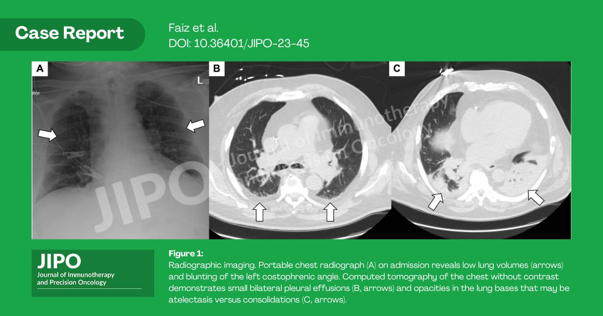 JIPO Editors (@jipoeditors) on Twitter photo Learn the importance of multidisciplinary workup and management of respiratory symptoms and insufficiency in this case study about a patient w renal cell carcinoma by Faiz et al. <a href="/ajaysheshadri/">Ajay Sheshadri</a> doi.org/10.36401/JIPO-… #immunotherapy #ICIs #JIPO <a href="/OncologyNetwork/">Innovative Oncology Network</a> Learn the importance of multidisciplinary workup and management of respiratory symptoms and insufficiency in this case study about a patient w renal cell carcinoma by Faiz et al. <a href="/ajaysheshadri/">Ajay Sheshadri</a> doi.org/10.36401/JIPO-… #immunotherapy #ICIs #JIPO <a href="/OncologyNetwork/">Innovative Oncology Network</a>