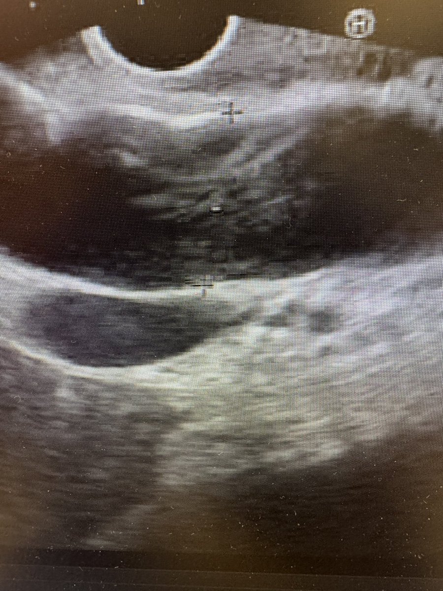 Sanmeet Singh MD (@sanmeetsingh07) on Twitter photo 94F with three failed ERCPs at two separate facilities
๐ 19 mm CBD on EUS
๐ Tx: Choledochoduodenostomy
๐ 6 mm x 8 mm LAMS
๐ 7 Fr double pigtail stent placed within the axios stent
<a href="/ASGEendoscopy/">ASGE GI Endoscopy</a> #gitwitter <a href="/bostonsci/">Boston Scientific</a> 94F with three failed ERCPs at two separate facilities
๐ 19 mm CBD on EUS
๐ Tx: Choledochoduodenostomy
๐ 6 mm x 8 mm LAMS
๐ 7 Fr double pigtail stent placed within the axios stent
<a href="/ASGEendoscopy/">ASGE GI Endoscopy</a> #gitwitter <a href="/bostonsci/">Boston Scientific</a>
