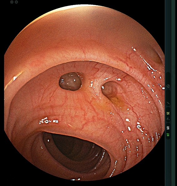 GI Surgeons of Twitter: recurrent diverticulitis after elective sigmoid colectomy should be RARE.

Most modern studies report a rate &lt;5%, and in my anecdotal experience it's probably closer to 1%.

The biggest predictor of recurrence is retained distal sigmoid colon with a