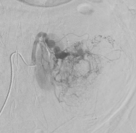🚨 #IRMinute Case
A young patient presents to the ED with sharp, stabbing left flank pain. A CT reveals the following :

🔍 What do you see on the CT?
🤔 What is the finding on the angiography?

Drop your thoughts below! Let’s discuss the findings and best approach. #MedTwitter