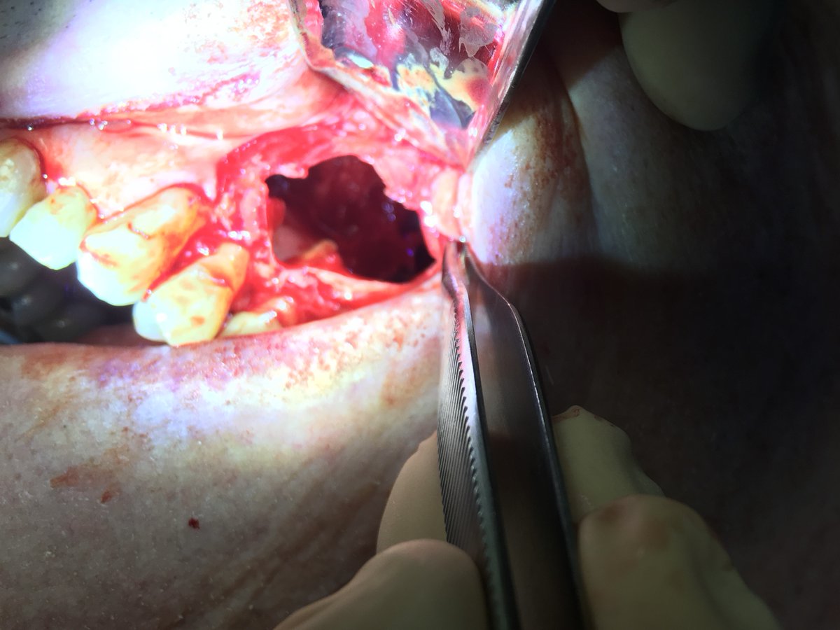 Large OKC left maxilla. I can’t believe this was not causing pain. He claimed he didn’t know it was there. His dentist found it.