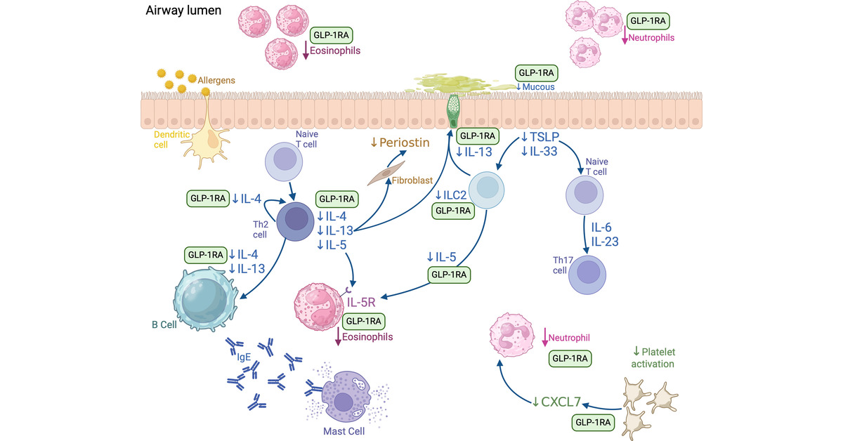 ATS Blue Journal (@atsblueeditor) on Twitter photo Obesity-related Asthma: A Pathobiology-based Overview of Existing and Emerging Treatment Approaches
Obesity can worsen asthma. The authors review current and promising treatments for obesity-related asthma
<a href="/EFornoMD/">Erick Forno, MD MPH</a>
<a href="/IUDeptPeds/">IU Department of Pediatrics</a>
<a href="/pedspulm/">IU_PedsPulm</a>
<a href="/ATSPeds/">ATSPeds</a>
🔗 tinyurl.com/ds4sr8mv Obesity-related Asthma: A Pathobiology-based Overview of Existing and Emerging Treatment Approaches
Obesity can worsen asthma. The authors review current and promising treatments for obesity-related asthma
<a href="/EFornoMD/">Erick Forno, MD MPH</a>
<a href="/IUDeptPeds/">IU Department of Pediatrics</a>
<a href="/pedspulm/">IU_PedsPulm</a>
<a href="/ATSPeds/">ATSPeds</a>
🔗 tinyurl.com/ds4sr8mv
