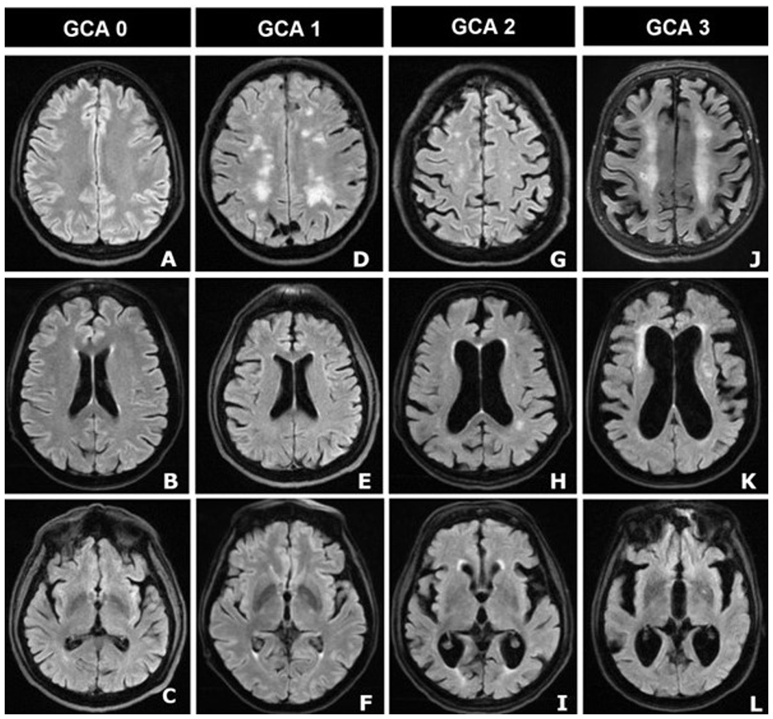 The Global Cerebral Atrophy Scale (AKA Pasquier Scale) evaluates ...