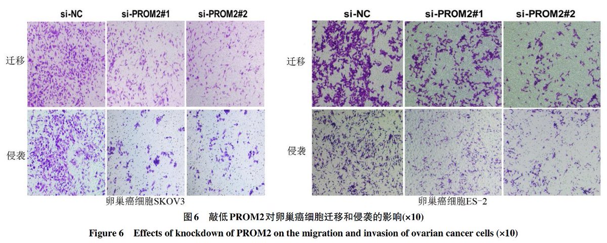 HainanJournal's tweet photo. Knocking down PROM2 stops ovarian cancer cells from growing and spreading while triggering their death by disrupting the WNT/β-catenin pathway!
#cancer #cell #medical 
@HainanJournal 
https://t.co/Yw85bETu3E https://t.co/9IkpX6uSjk