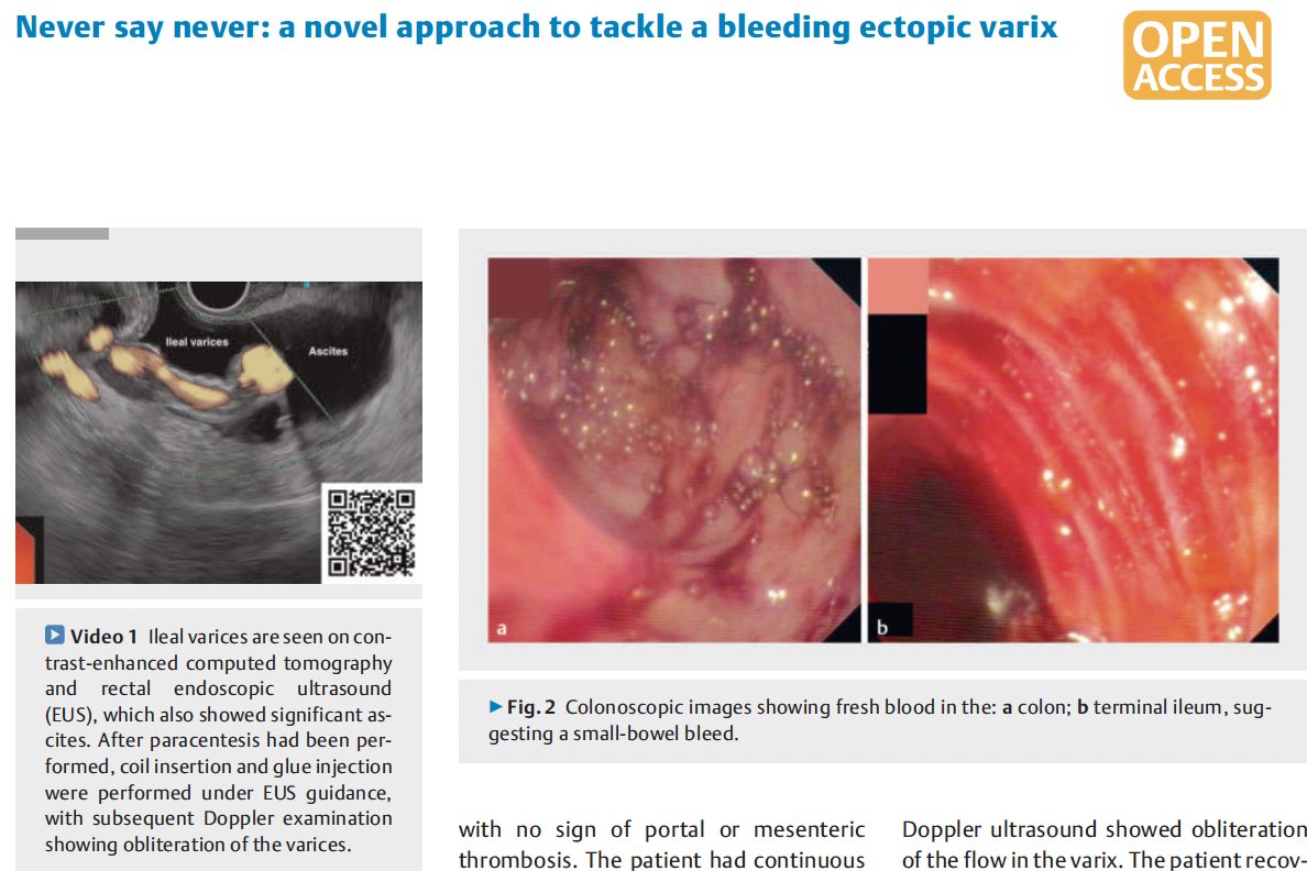saurabhmukewar's tweet image. Our latest article on an ectopic varix case managed with EUS..
youtu.be/HSZqj14-ZKk
thieme-connect.com/products/ejour…