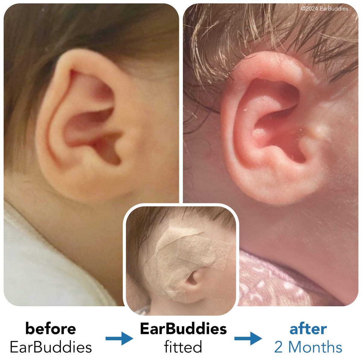 EarBuddies's tweet photo. Jessica permanently corrected her baby’s ear with @EarBuddies  • ‘We wore these for 2 months at 2 months old. We are sooooo thankful that there was such a cost effective solution! Thank you EarBuddies!’

Find out more at https://t.co/0GxIet1fMu

#EarBuddies #parenting #babyears https://t.co/558fxudWdz