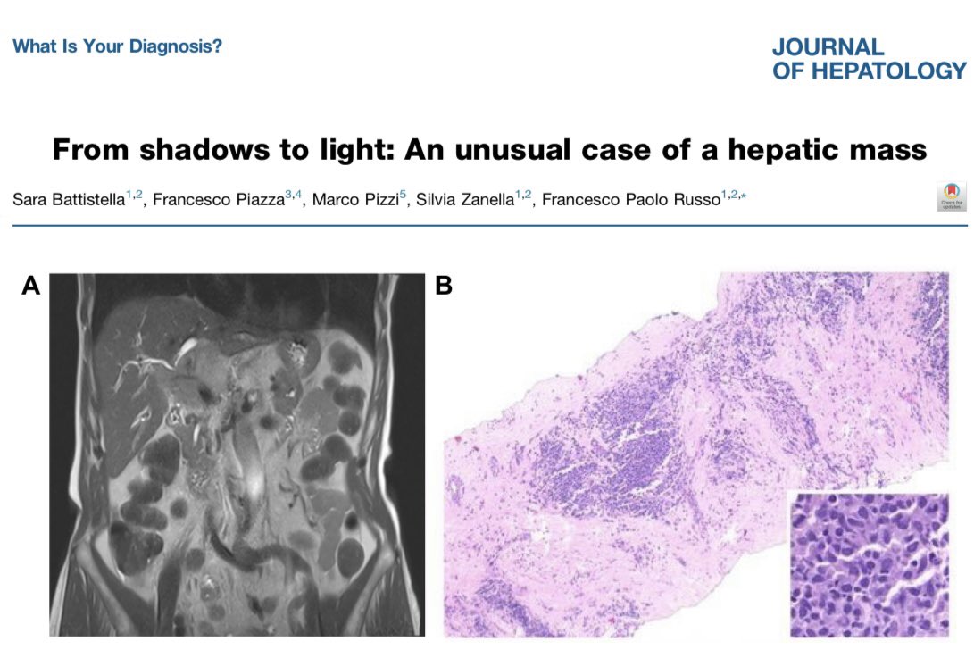Sara Battistella (@s_battistellamd) on Twitter photo Calling for medical Sherlocks!! 🕵🏻♂️🕵🏻
Test your skills, a new dilemma is waiting for you! ⏰⏰
<a href="/JHepatology/">Journal of Hepatology</a> <a href="/EASLedu/">EASL Education</a> <a href="/EASLnews/">EASLnews</a>
sciencedirect.com/science/articl… Calling for medical Sherlocks!! 🕵🏻♂️🕵🏻
Test your skills, a new dilemma is waiting for you! ⏰⏰
<a href="/JHepatology/">Journal of Hepatology</a> <a href="/EASLedu/">EASL Education</a> <a href="/EASLnews/">EASLnews</a>
sciencedirect.com/science/articl…