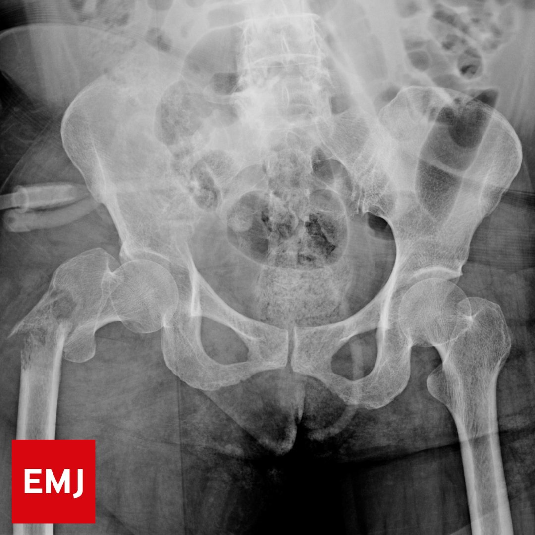 #November2024

Delayed admission of patients with hip fracture from the emergency department is associated with an increased mortality risk and increased length of hospital stay

Delayed disposition was independently associated with an increased mortality risk at 90 days and at