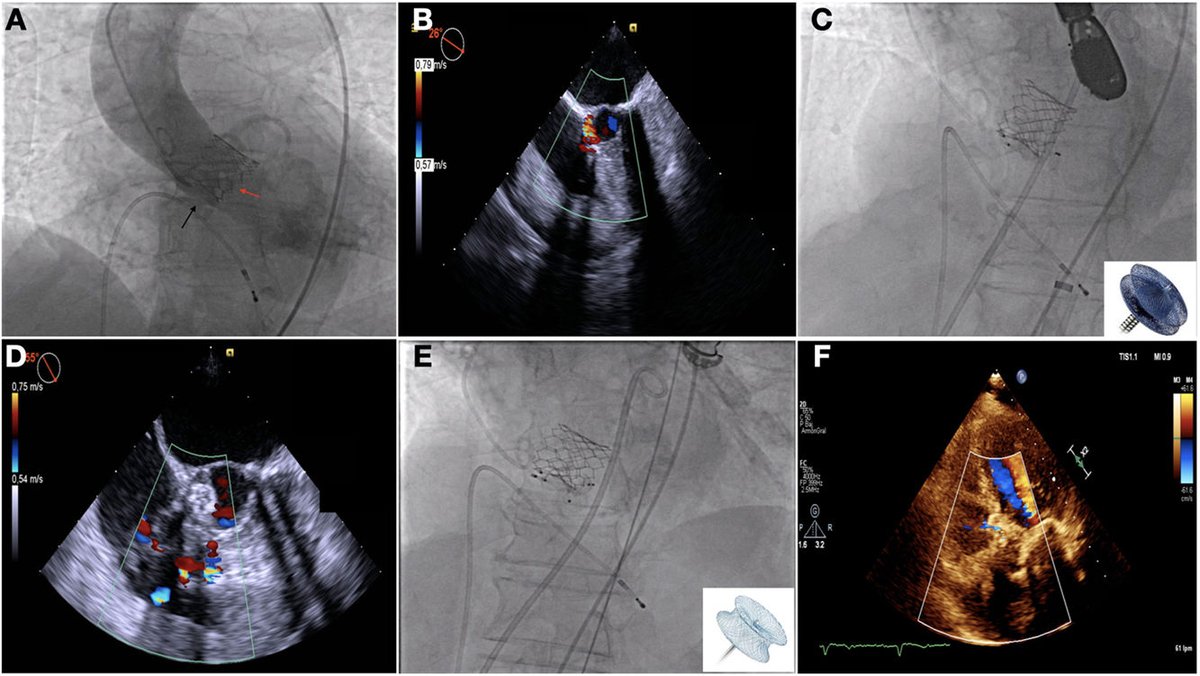 RevEspCardiol's tweet photo. Solución percutánea para rotura del anillo aórtico tras TAVI transfemoral #reccardioclinics @luisfergon82 @Juancar_Astorga @Rblancomata https://t.co/ng3XtUCpbE https://t.co/cIDZlbkf3g