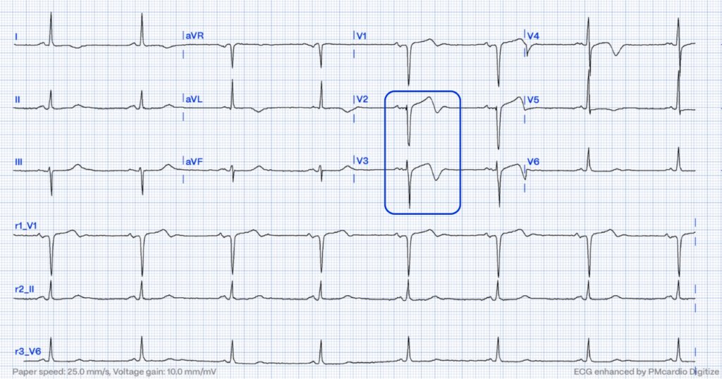 📌 Wellens’ Syndrome
•🚨 Critical stenosis of LAD
•🎯 Biphasic or deeply inverted T waves in V2-3

▶️ Diagnostic Criteria
1️⃣ T waves: Deeply inverted or biphasic in V2-3 (may extend V1-6).
2️⃣ ST segment: Isoelectric/minimal elevation (< 1 mm).
3️⃣ Q waves: Absent precordially.