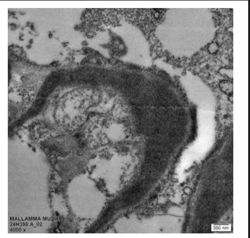 Basavarajss90's tweet photo. @VamsidharV17 @MedTwX @arkanalabs @meyyappannephro @SethiRenalPath Electron dense deposits + https://t.co/kpo1uKBkuE