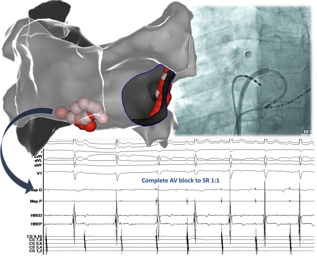 Michail Efremidis (@mefraimidis) on Twitter photo Cardioneuroablation for treatment of complete AV block in a 28y old patient
<a href="/SteliosDragasis/">Stelios</a> <a href="/ipetemil/">Panagiotis Mililis</a> <a href="/athsaplaouras/">Athanasios Saplaouras</a> <a href="/Kariki_O/">Ourania Kariki</a> <a href="/K_Letsas/">Konstantinos Letsas</a> <a href="/CosmoValkanas/">Kosmas Valkanas</a> #EPeeps Cardioneuroablation for treatment of complete AV block in a 28y old patient
<a href="/SteliosDragasis/">Stelios</a> <a href="/ipetemil/">Panagiotis Mililis</a> <a href="/athsaplaouras/">Athanasios Saplaouras</a> <a href="/Kariki_O/">Ourania Kariki</a> <a href="/K_Letsas/">Konstantinos Letsas</a> <a href="/CosmoValkanas/">Kosmas Valkanas</a> #EPeeps