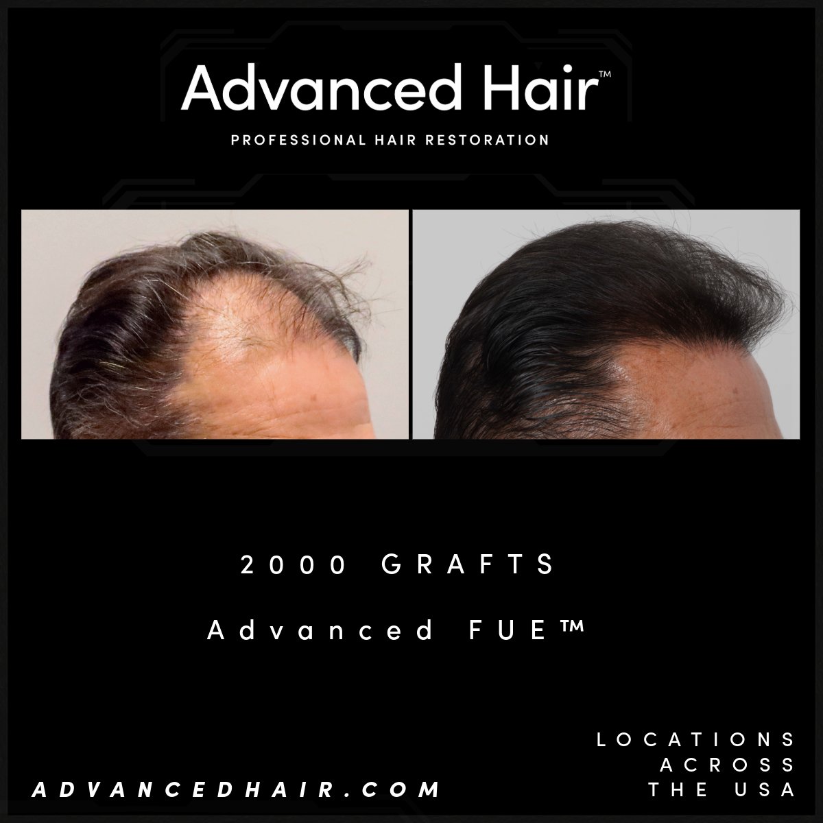 GoAdvancedHair's tweet photo. 🫵 Our Advanced FUE® hair transplant protocol and tech are what make Advanced Hair Restoration the leader in FUE hair transplants (Moves one follicle at a time, no doll hair look, no linear scar, just natural looking results). 

🥼Our techniques are unmatched🔬

Click this >> https://t.co/wk65kJgJ13  for more info & to book a FREE consultation today. 

#AdvancedHair #FueHairTransplant #OwnYourLook #HairRestoration #hairtransplant #usahairtransplant