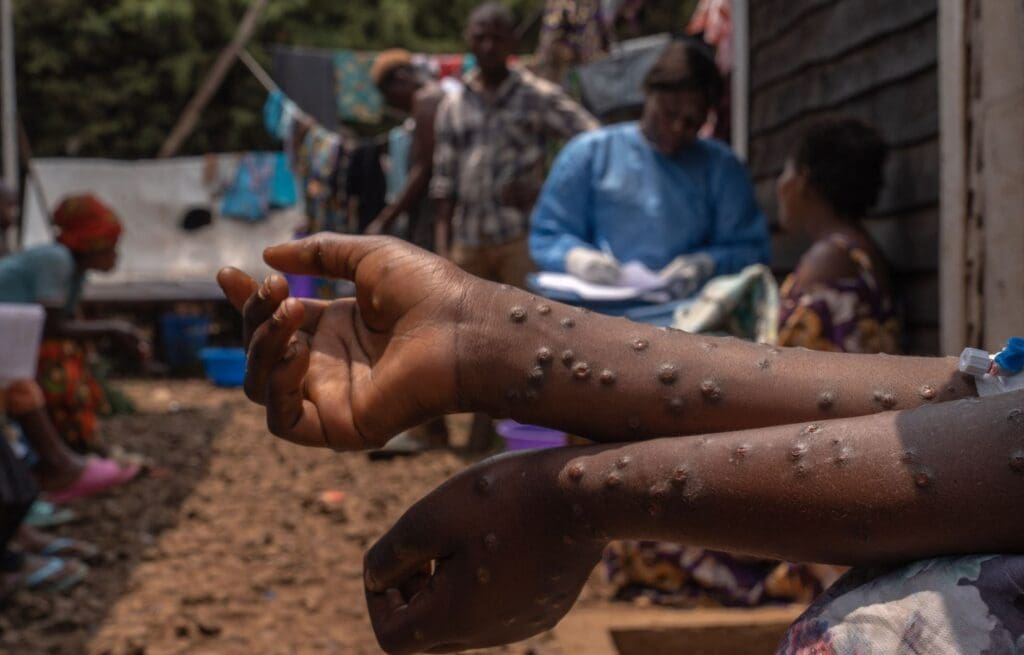 🌍🚨 Mpox en RDC : Alerte maximale maintenue par l'OMS ! 🚑

L'épidémie persiste en République Démocratique du Congo. Restez vigilants et informés. Détails ici: 1l.ink/S7HSNBG

#Mpox #SantéPublique #RDC