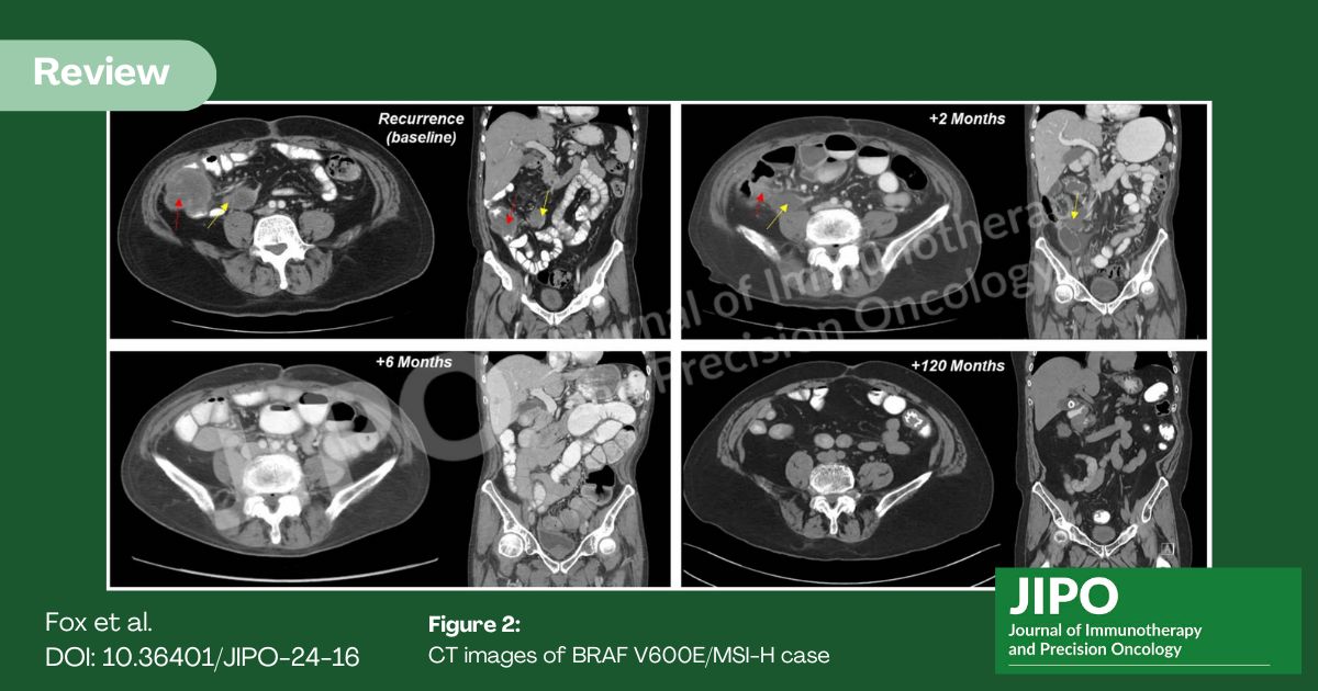 JIPO Editors (@jipoeditors) on Twitter photo Review recent #JIPO case study by Fox et al. "Durable remission after targeted therapy in BRAF V600E-mutant metastatic colorectal cancer" doi.org/10.36401/JIPO-… #vemurafenib #colorectalcancer #dMMR <a href="/OncologyNetwork/">Innovative Oncology Network</a> Review recent #JIPO case study by Fox et al. "Durable remission after targeted therapy in BRAF V600E-mutant metastatic colorectal cancer" doi.org/10.36401/JIPO-… #vemurafenib #colorectalcancer #dMMR <a href="/OncologyNetwork/">Innovative Oncology Network</a>