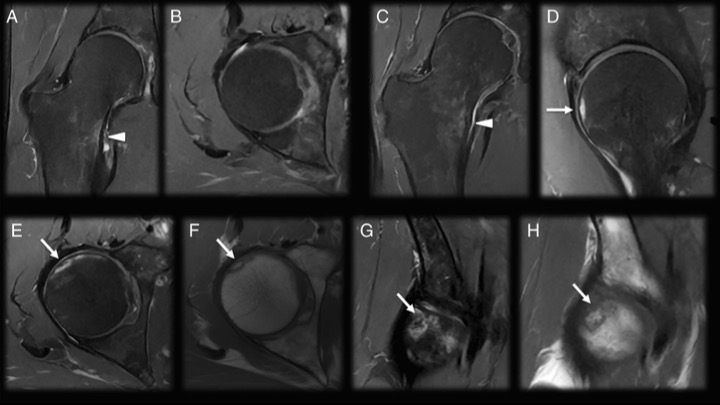 Julio B. Guimaraes, MD, PhD (@juliobguimaraes) on Twitter photo Dear friends! We just published at <a href="/skeletaljournal/">Skeletal Radiology</a> a series of cases about bone marrow abnormalities as an adverse effect of therapeutic diathermy, visualized with MRI.Some cases can be very challenging if we have never seen these changes. doi.org/10.1007/s00256… Dear friends! We just published at <a href="/skeletaljournal/">Skeletal Radiology</a> a series of cases about bone marrow abnormalities as an adverse effect of therapeutic diathermy, visualized with MRI.Some cases can be very challenging if we have never seen these changes. doi.org/10.1007/s00256…