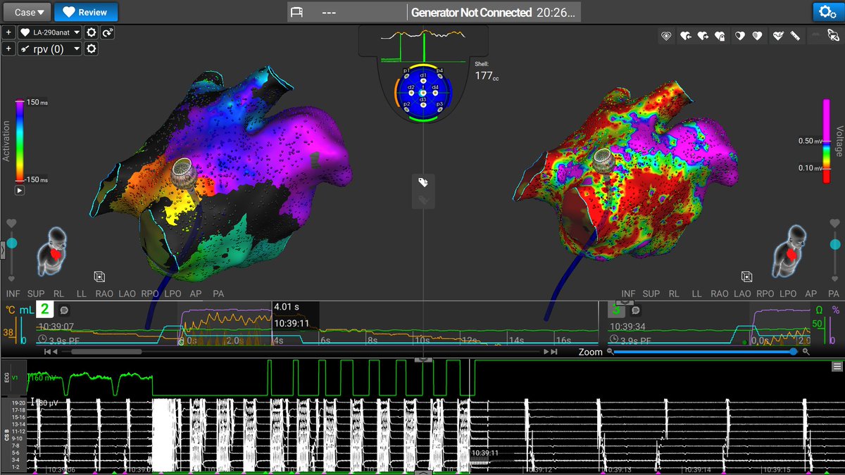 First (RF) application resulted in tachy CL prolongation (almost 100 ms), and the second (PFA) application at the same site, performed to increase lesion depth, ended the tachycardia 🥳🎉. Some epicardial involvement might have been present.